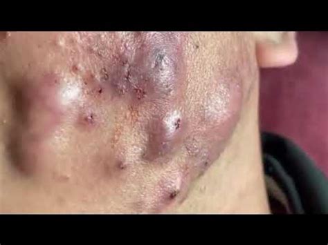 In Britain, land of the elegance and yet the subtle humor, a man recently became famous by the depth and sound quality of his intestinal fragrances. . Pimple popping videos guinness world records